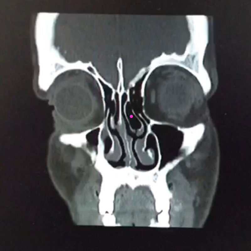Burnun bilgisayarlı tomogrofi ile görünümü