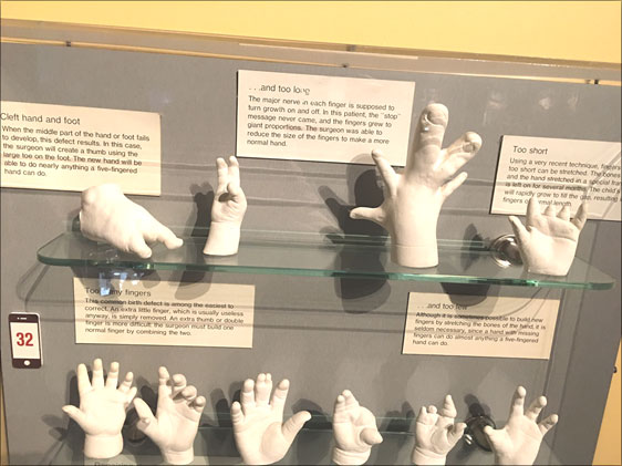 Boston Bilim Müzesi'nde sergilenen el ve ayak anomalilerinden bazıları.