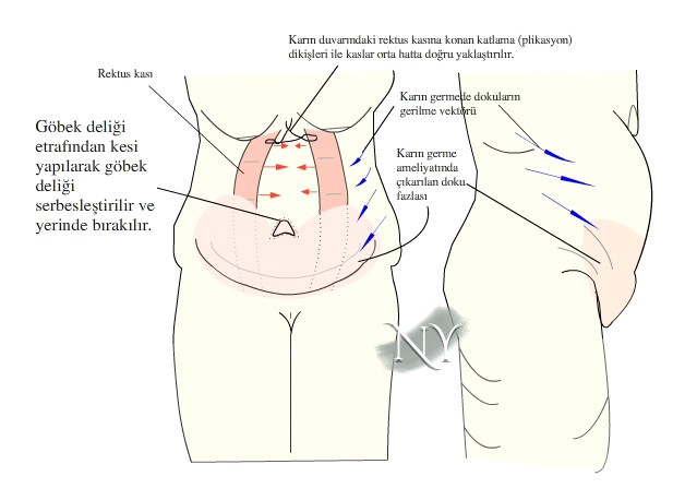 Karın germe ameliyatında çıkarılan dokular ve rektus kasına konulan katlama (plikasyon) dikişleri