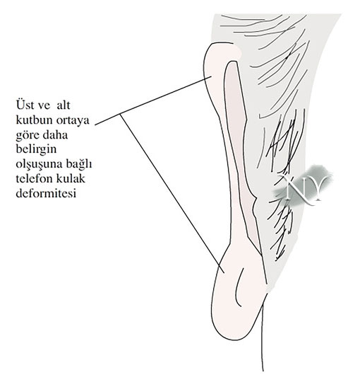 Kulakta orta seviyenin aşırı düzeltimi ya da kulak memesi veya üst kutbun yetersiz düzeltimine bağlı telefon kulak deformitesi.