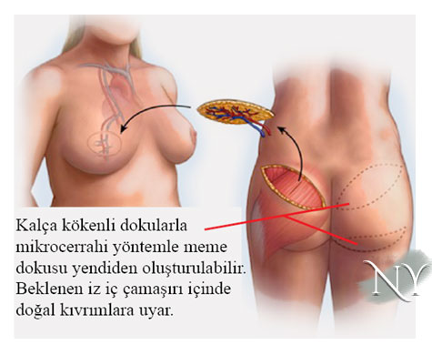 Kalça dokusu ile memenin yeniden oluşturulması.